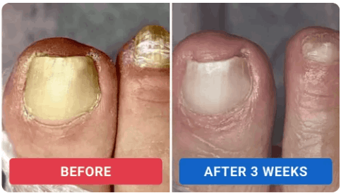 Orville Anti Fungus Review