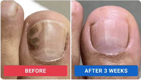 Orville Anti Fungus User Review